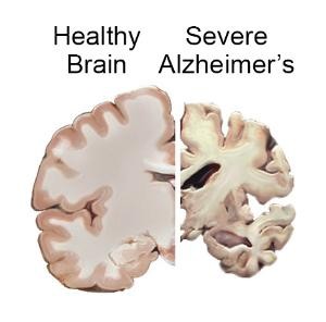 https://neuro.gatech.edu/sites/default/files/Hg_News/Alzheimers.pTau_.Data__0.jpg https://neuro.gatech.edu/sites/default/files/Hg_News/Alzheimers.pTau_.Data__0.jpg