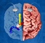 https://neuro.gatech.edu/sites/default/files/Hg_News/thumbs/Deep_Brain_Stimulation.jpg https://neuro.gatech.edu/sites/default/files/Hg_News/thumbs/Deep_Brain_Stimulation.jpg
